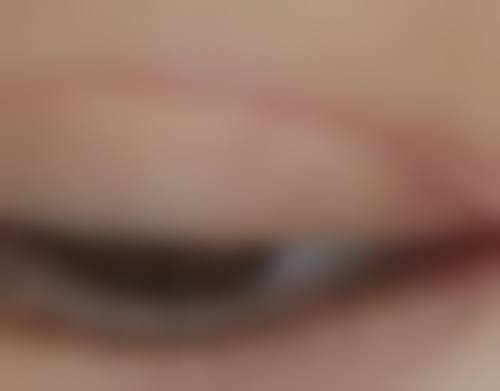 种植发际线的注意事项