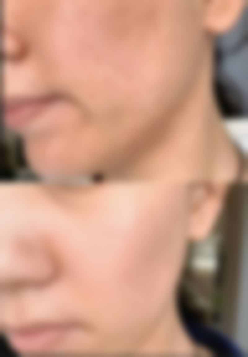 打完瘦脸针可以洗热水澡吗