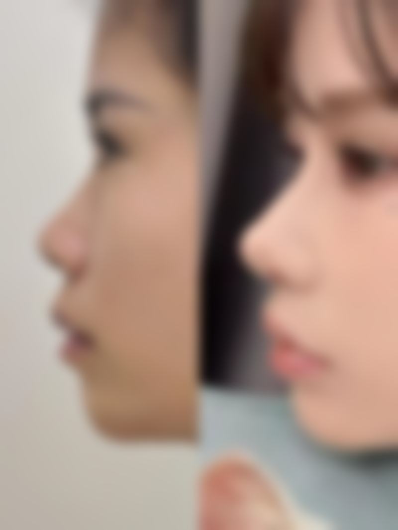 刚打完瘦脸针可以泡澡吗