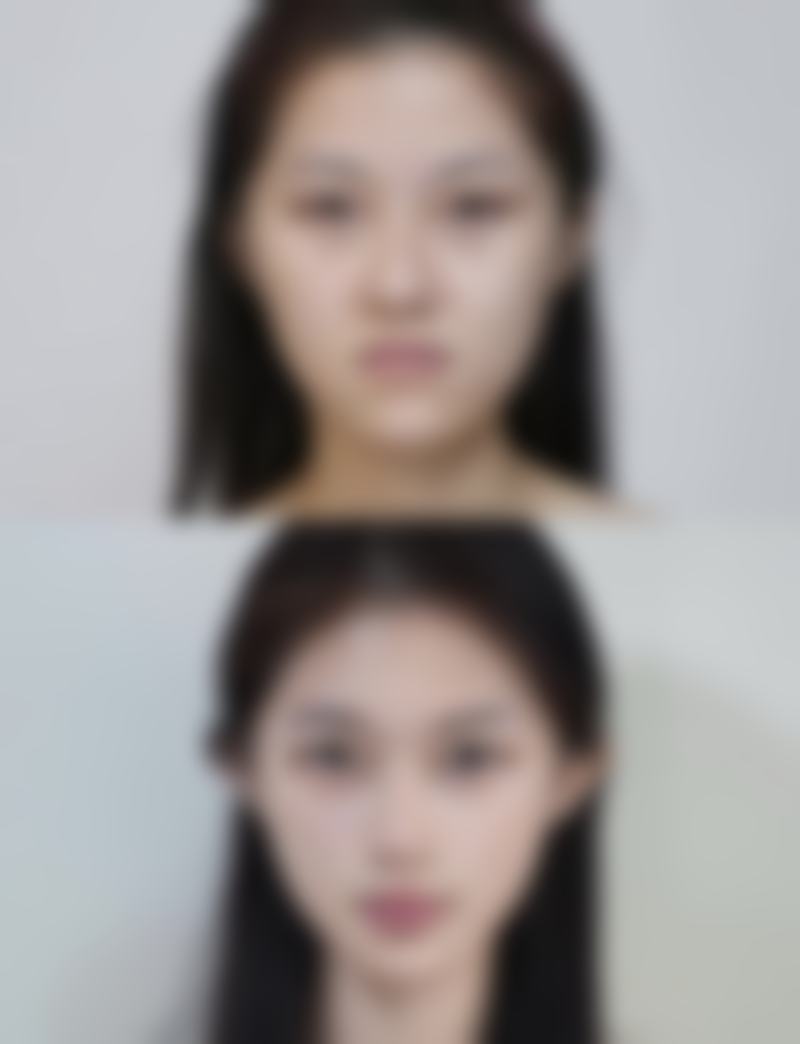 眼角长期打除皱针有什么副作用？掌握3大应对方法，让你安全抗衰保持年轻光彩！ 