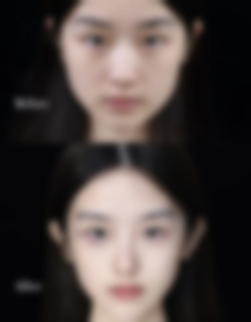 打瘦脸针有后遗症吗