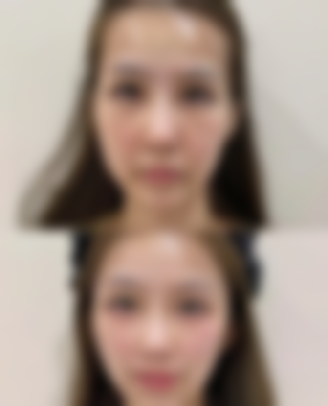 打完瘦脸针可以淋浴洗头吗