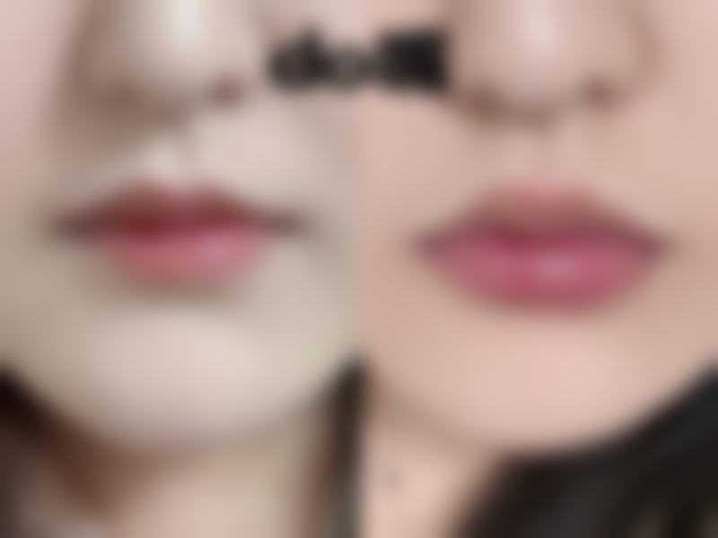 头发种植价格一般多少钱