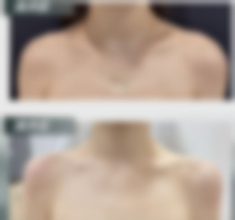 头发种植手术有效果吗？权威数据揭示95%成功率，真实案例证明重塑浓密秀发不再是梦 