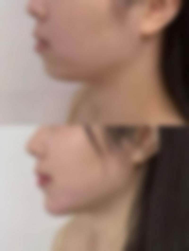 打瘦脸针会垮脸吗