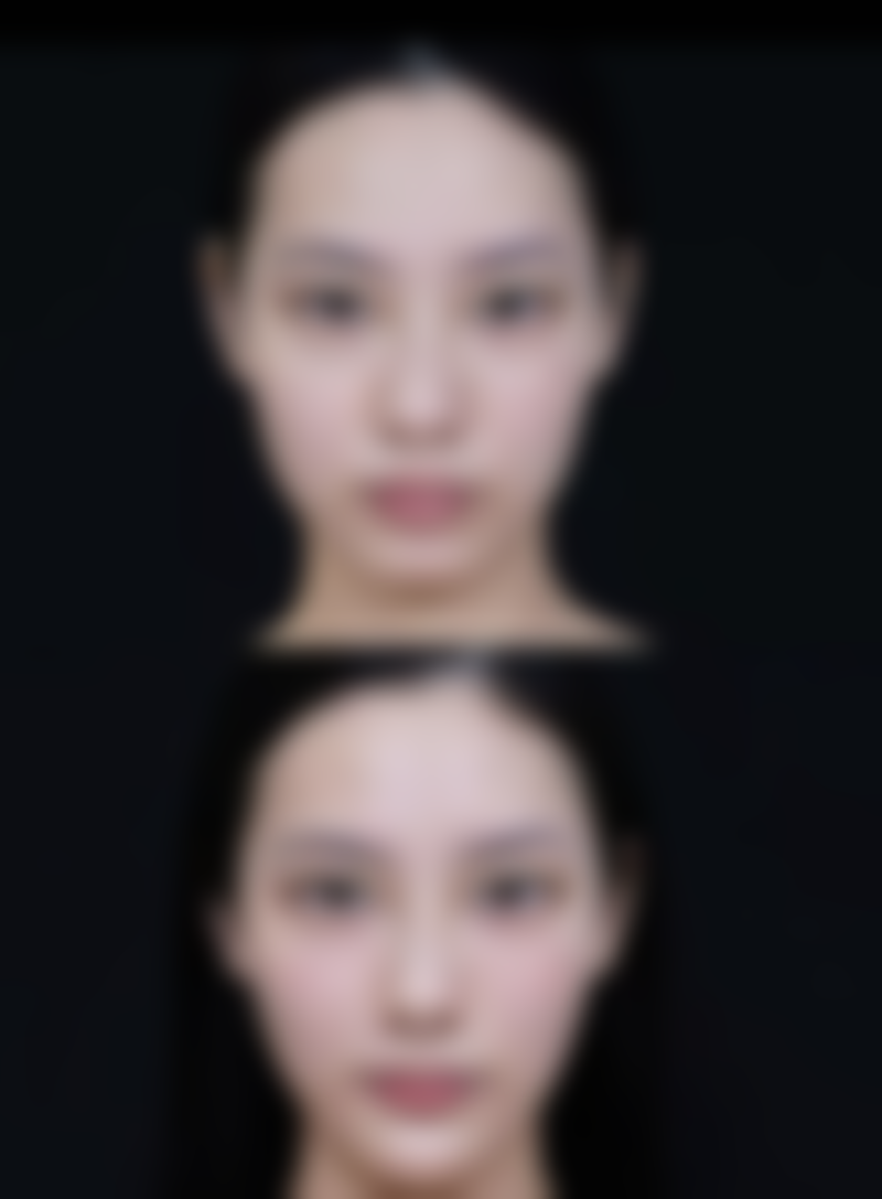 种植发际线能维持多久？正规操作下可维持10 - 15年，毛囊存活后效果持久稳定优势多！ 