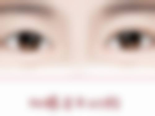 阴式子宫切除 + 阴道前后壁修补术