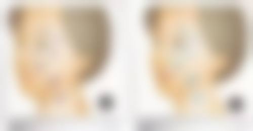 韩国除皱一般多少钱