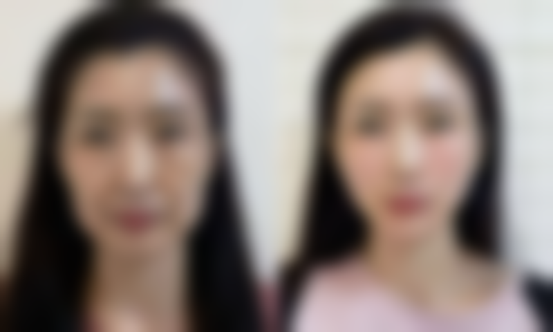 玻尿酸注射增粗的价格