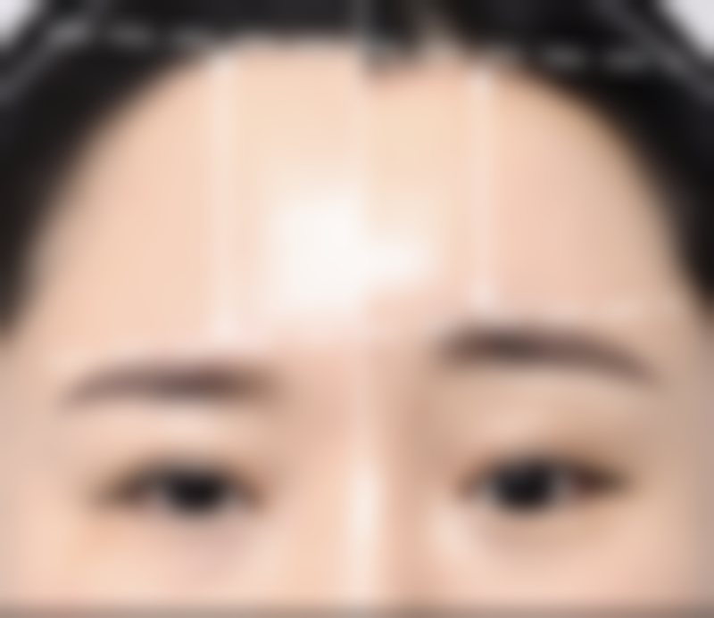 玻尿酸注射多少钱一针