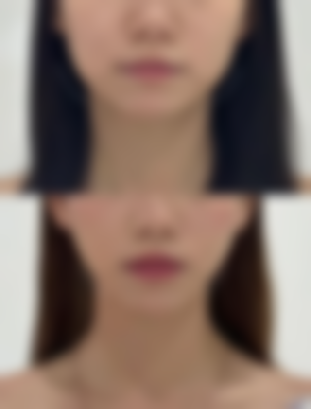 打完除皱多久可以做面部护理