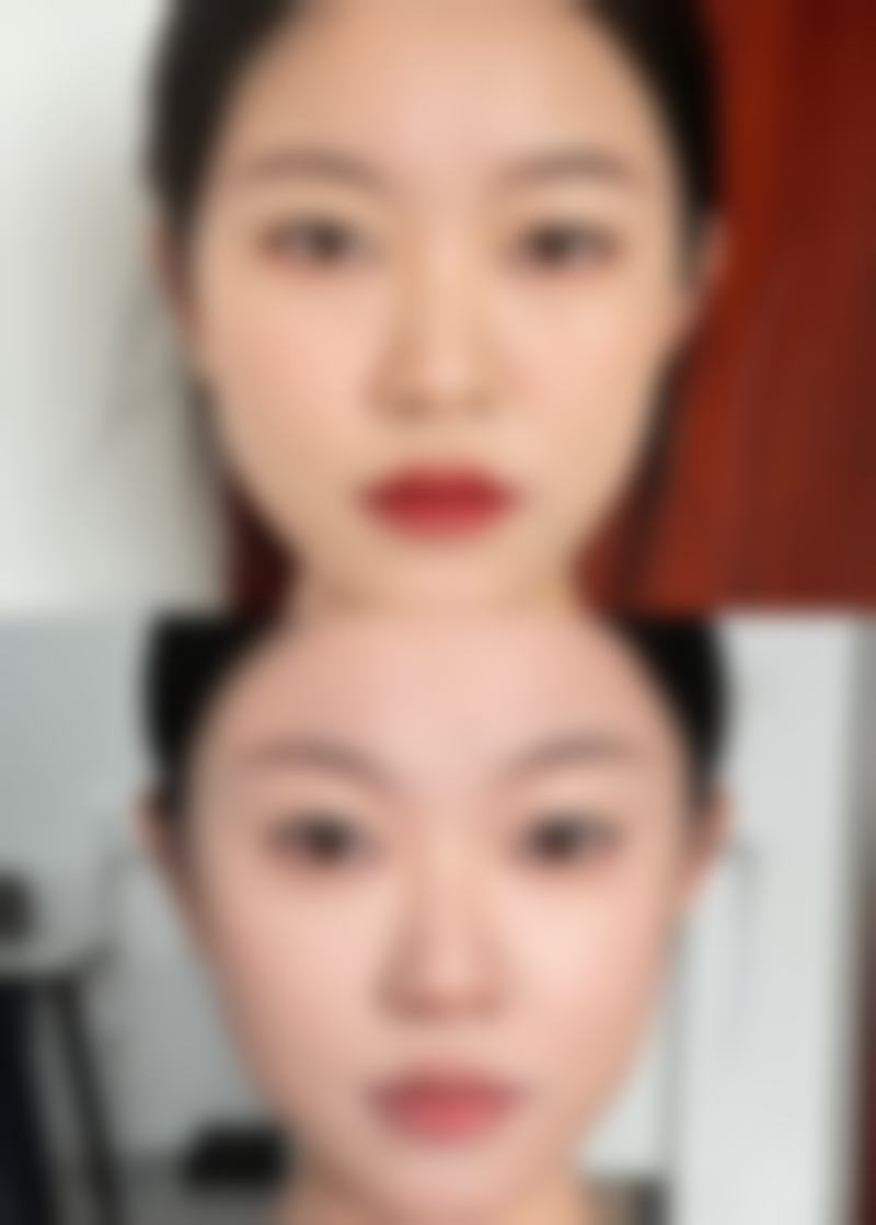 玻尿酸项目的价格参考