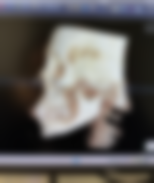 阴道紧缩术后多久可以性生活