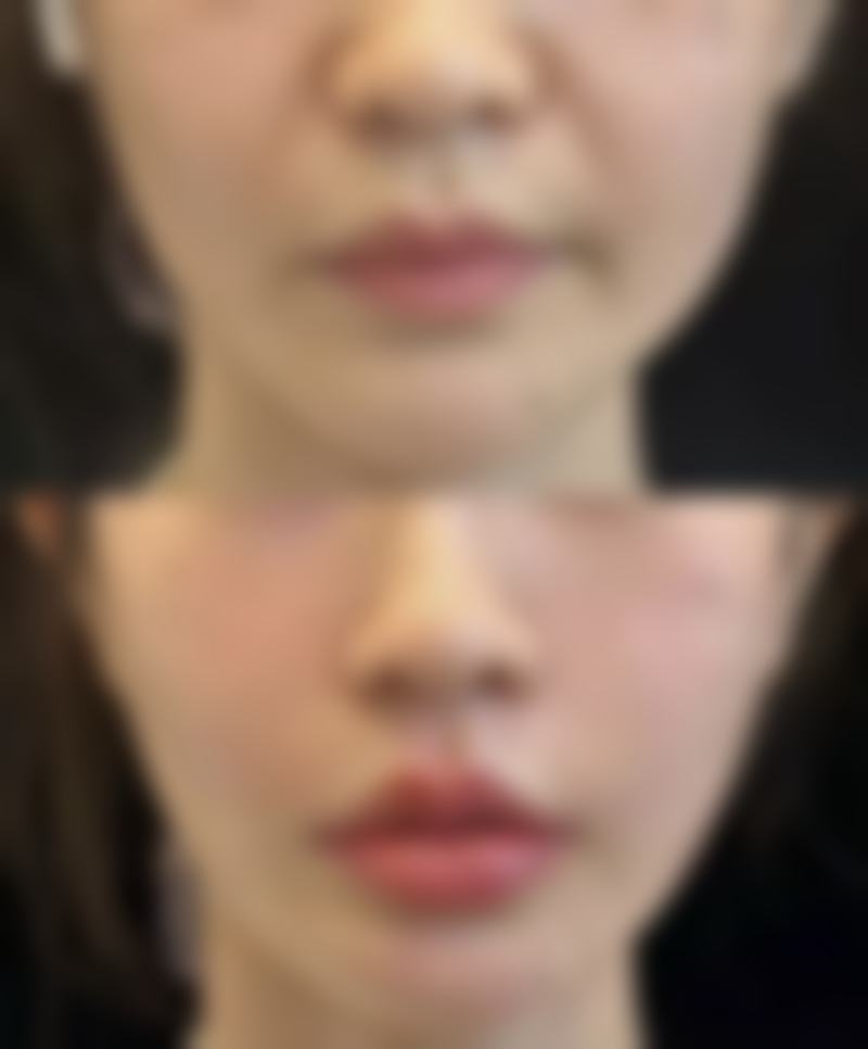 小阴唇不对称的影响