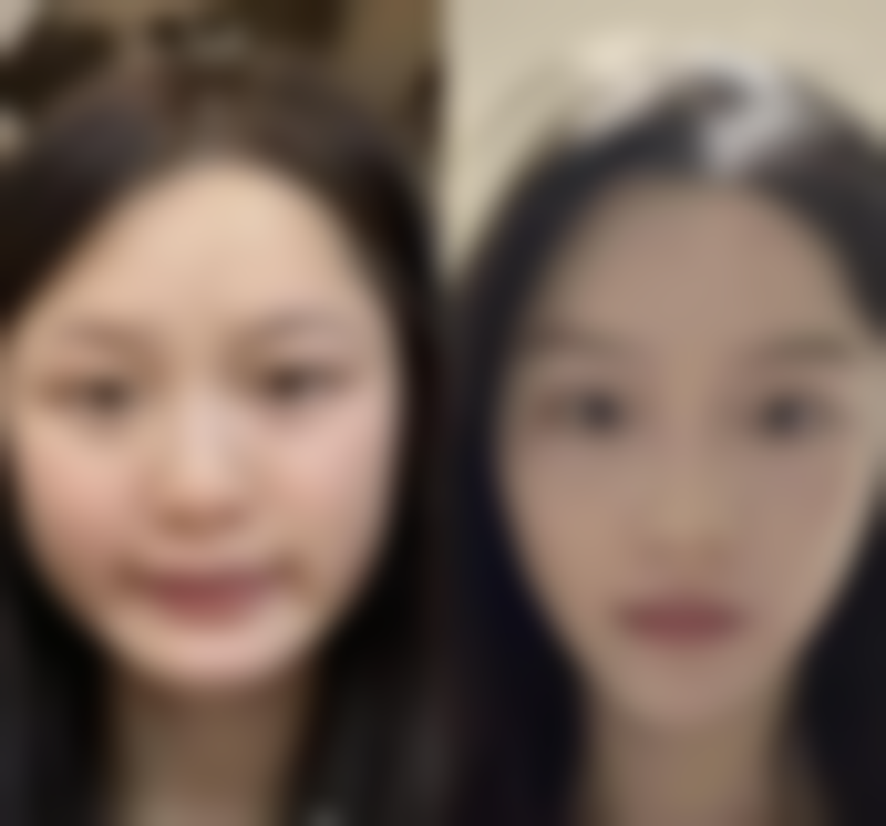 小阴唇不对称怎么缩小？揭秘医美4大有效方法，让你告别不对称尴尬，重拾自信！ 