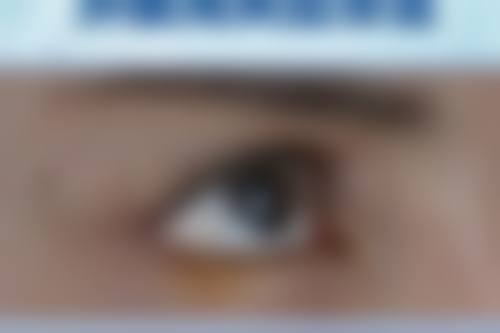 做M唇手术过程是什么样的