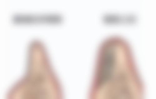 做M唇手术的危害