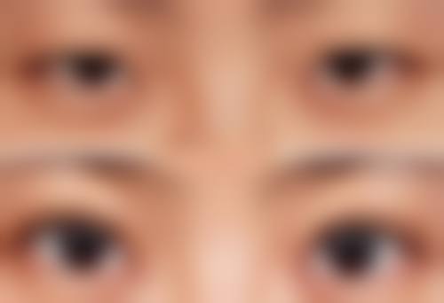 注射溶脂：适合脂肪堆积型厚唇