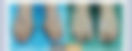 M唇手术过程需要多久