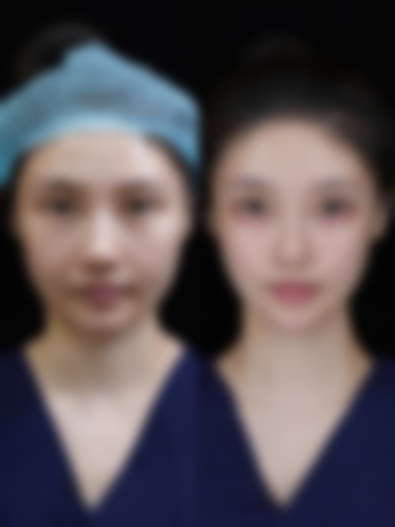 种植发际线多久自然