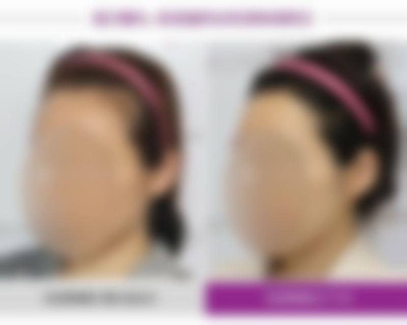 瘦脸针瘦脸能瘦多少？揭秘瘦脸针神奇效果，平均可瘦2-3厘米，让你轻松拥有精致小V脸！ 