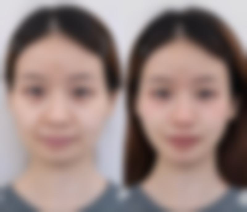 注射瘦脸针的后遗症