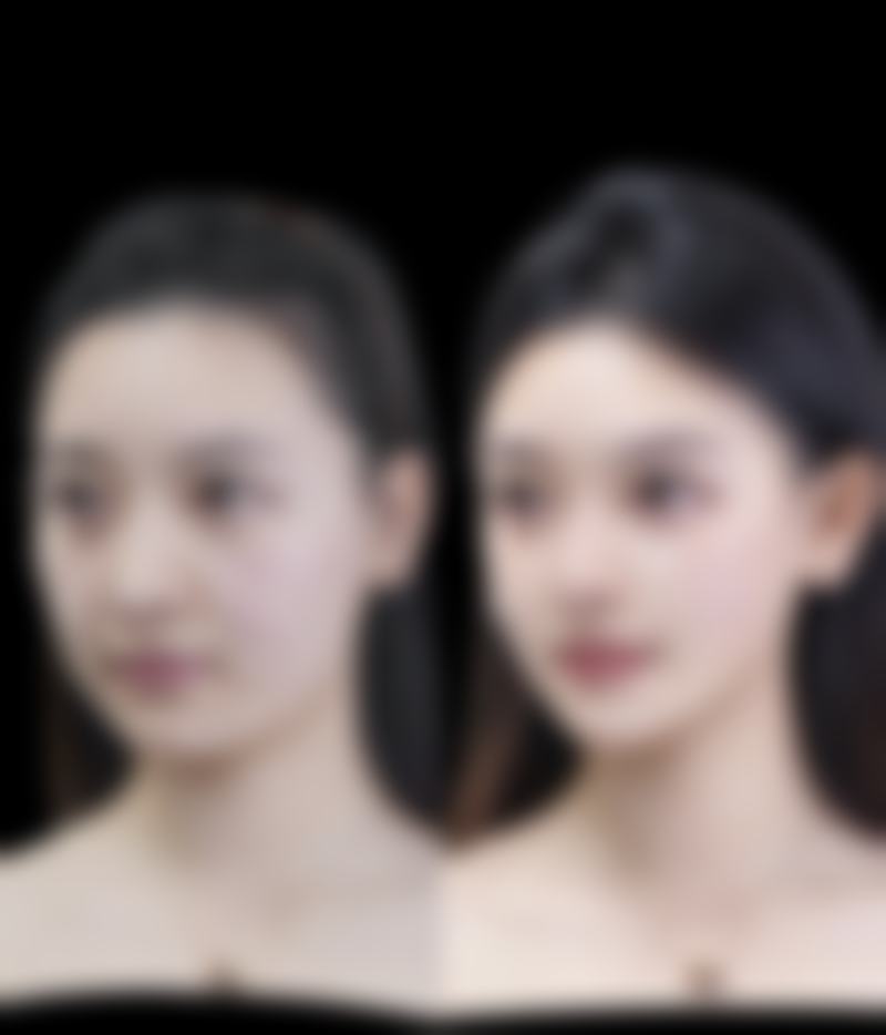 毛发种植后头发的生长情况