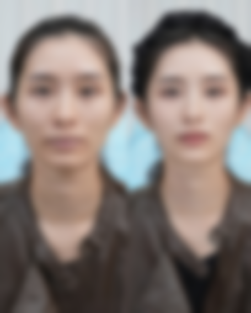 瘦脸针瘦脸好不好?