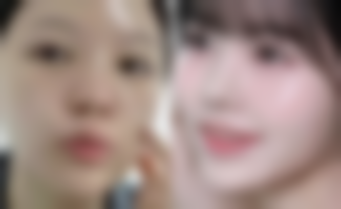 额头高可以种植发际线吗