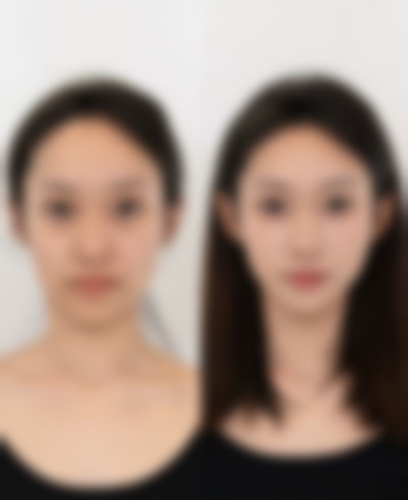 种植发际线多久开始脱落