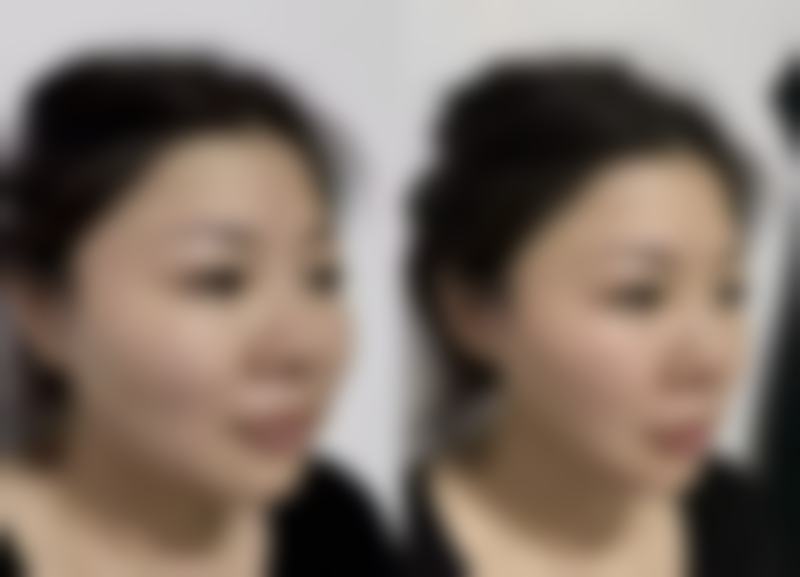 种植的头发多久可以稳固扎根?