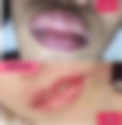 下颌缘提升和瘦脸针一起打多少单位