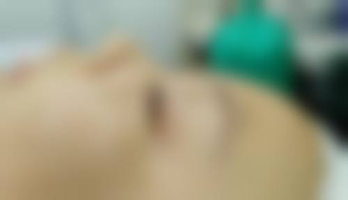 瘦脸针能不能打,安不安心?