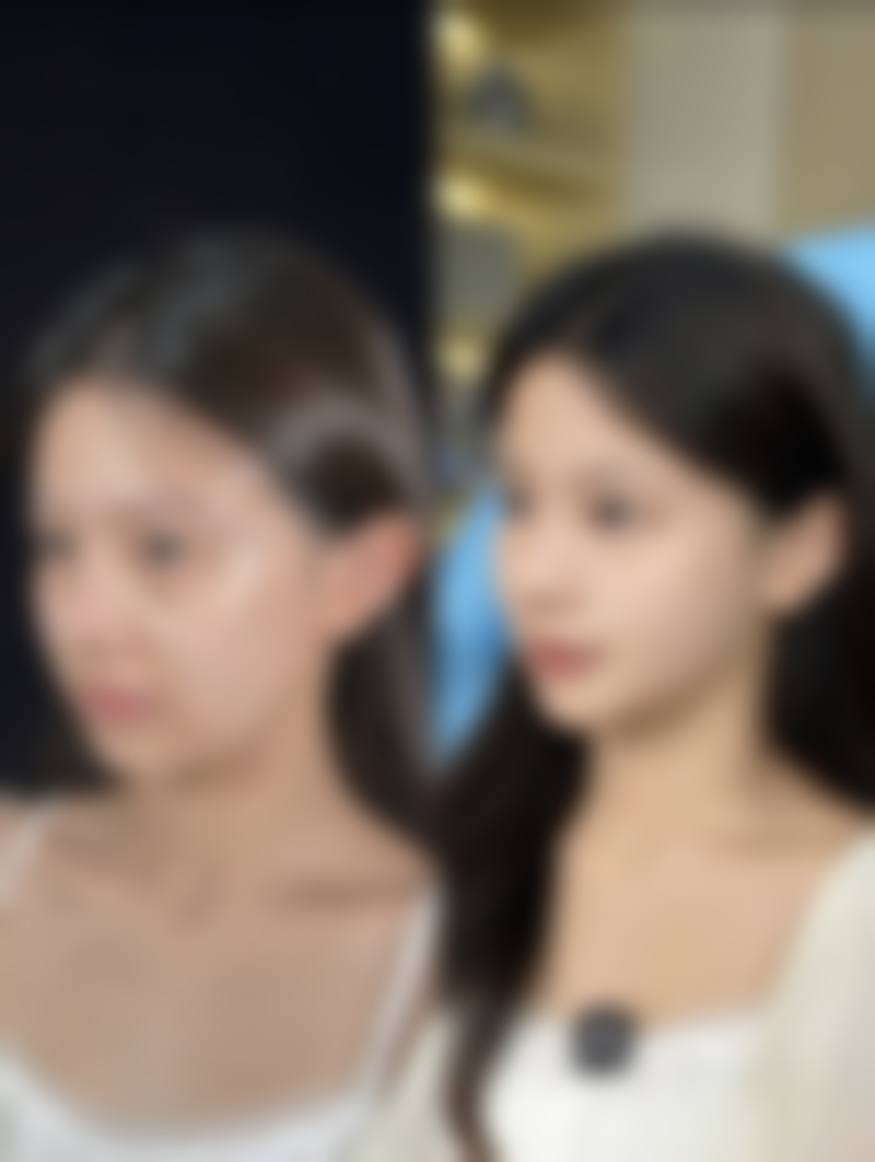 瘦脸针打完咬肌会修复原样