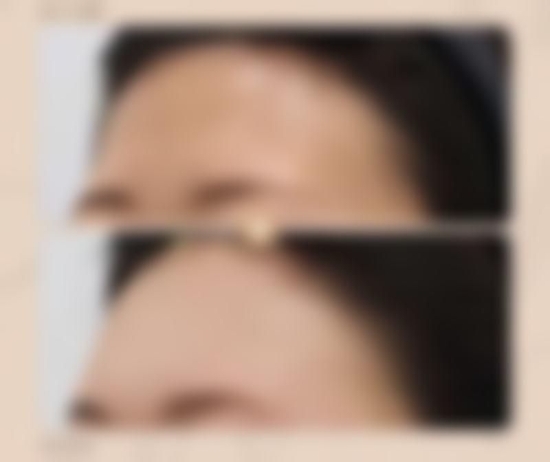 提升下颌缘和瘦脸针有什么区别？了解两者差异，为你揭秘哪种医美方式更能打造精致小V脸！ 