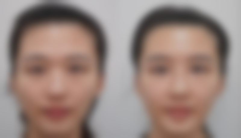 瘦脸针的见效时间