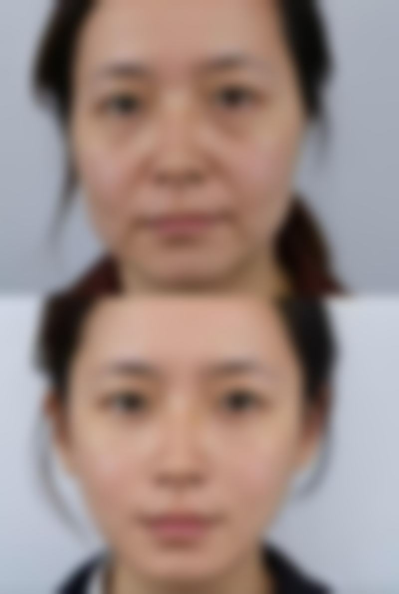 瘦脸针能不能打在脸上和鼻子上?