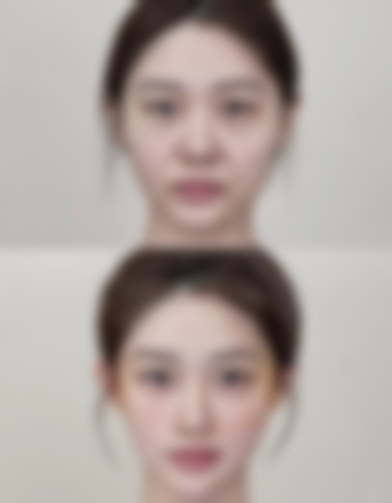 打瘦脸针咬肌会不会越来越大