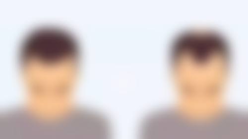 打瘦脸针的注意事项