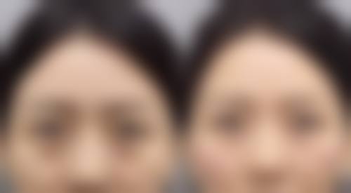 嘴凸手术算整容吗