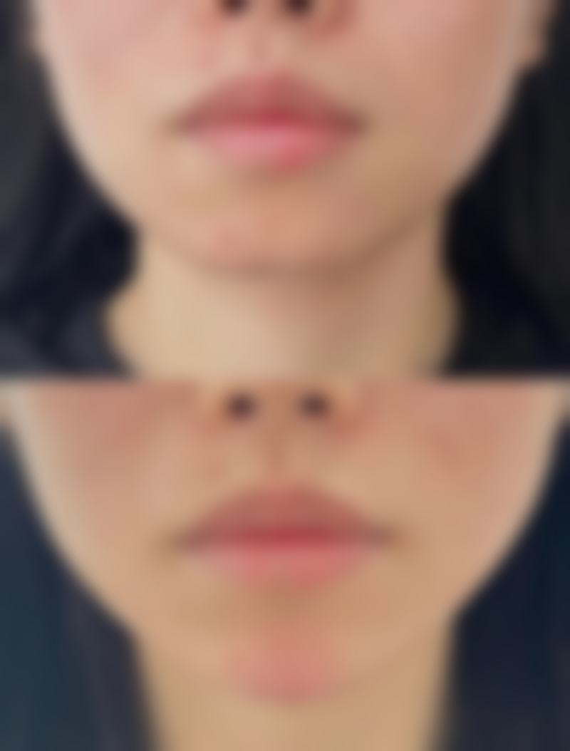 瘦脸针要一直打下去么对身体有害吗？了解其原理和科学打法，让你安全拥有紧致小V脸！ 