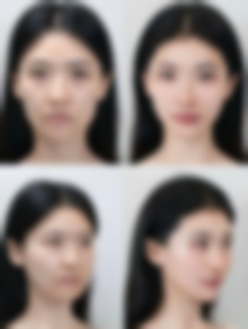 打瘦脸针老了的常见疑问解答