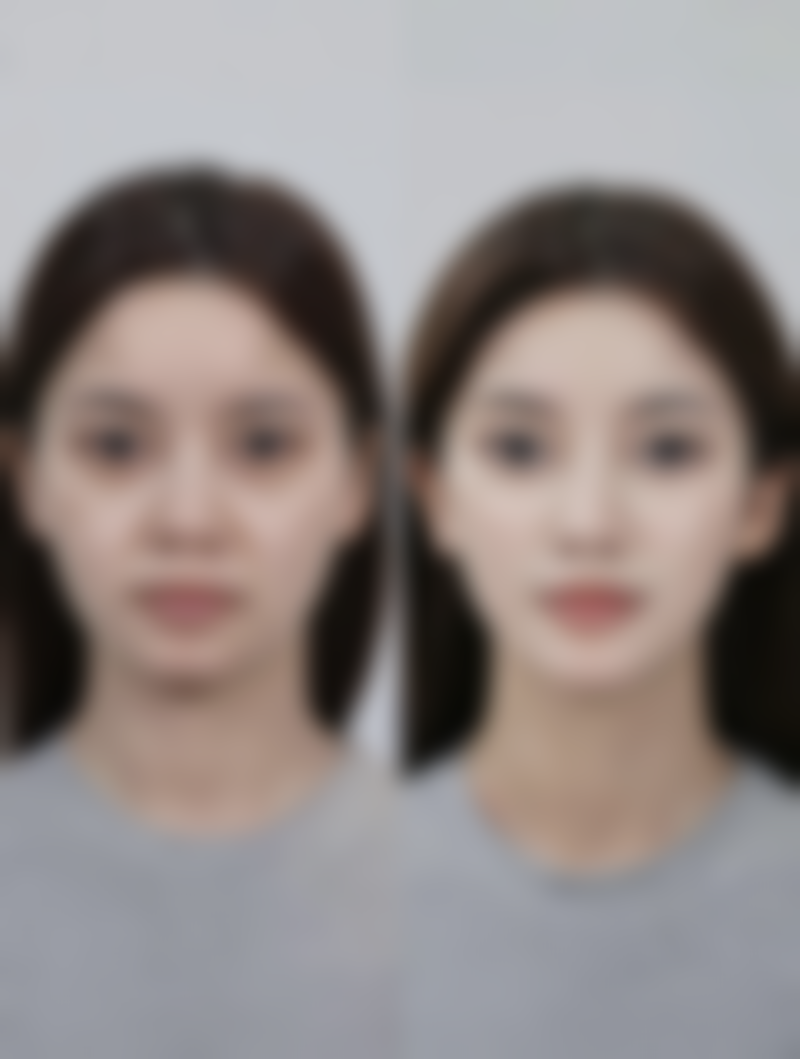 瘦脸针对身体有害吗