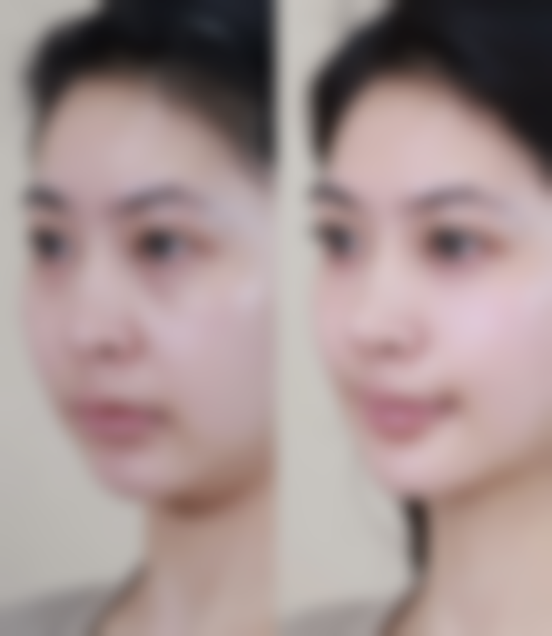 瘦脸针打一次就可以吗？揭秘1次瘦脸针效果、维持时间及后续护理，让你轻松拥有小V脸！ 