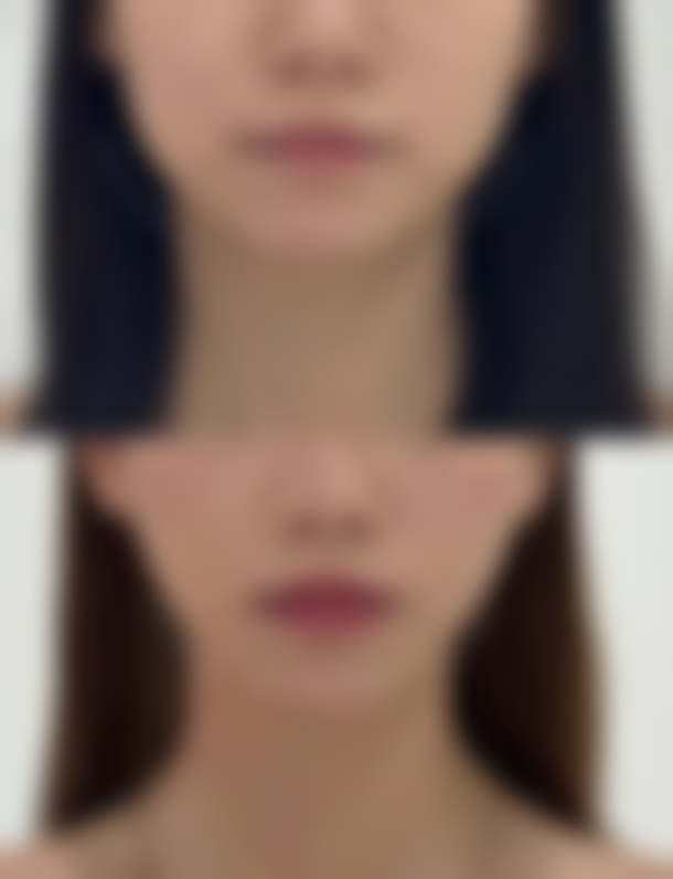 打瘦脸针老了会有影响吗？科学解析其潜在影响，揭秘3大长期优势让你美丽无忧！ 