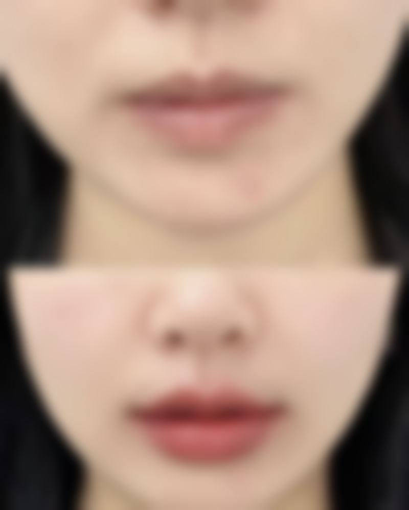 嘴凸的人可以做丰唇吗