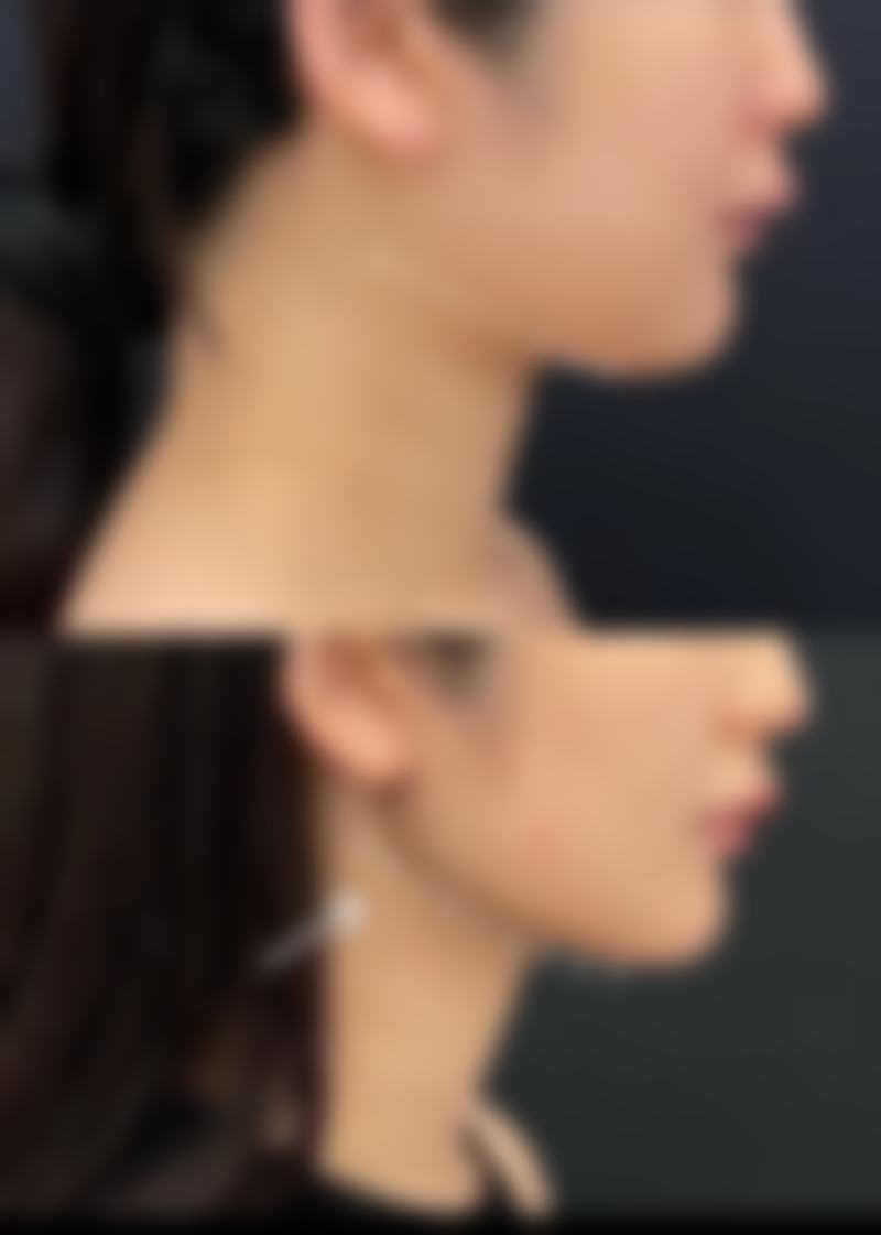 瘦脸针打几次就恒久了？