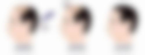 瘦脸针打咬肌多久有成效