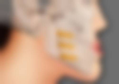 瘦脸针多久打一次成效至佳