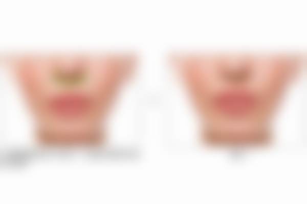 北京蕾士悦容医美莫娜丽莎稳固 PRO 玻尿酸轮廓固定项目实例/口碑